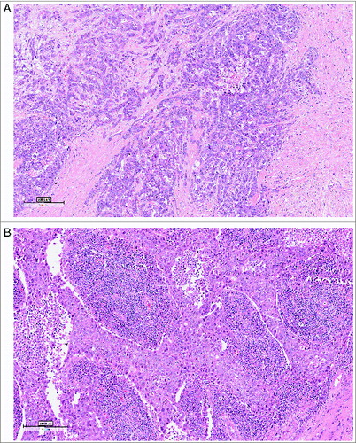 Figure 1. Tumor infiltrating lymphocytes, for quantification on H&E-stained sections. Examples of a TIL low (A) and TIL rich (B) primary triple negative breast cancer (magnification 10 ×).