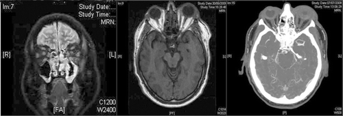 FIGURE 2  Coronal MRI showing mucosal thickening within the paranasal sinuses (left). Axial MRI showing bilateral orbital proptosis, more severe on the left (centre). CTA showing normal cavernous sinuses in the arterial phase (right).