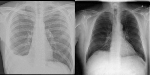 Figure 4. Left: Tuberculosis. Right: Healthy/Normal.