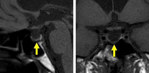 Figure 2 Magnetic resonance imaging of the pituitary. T1-weighted magnetic resonance images, without contrast, are shown. Left, Sagittal plane. Right, coronal plane. Yellow arrows indicate an empty sella.