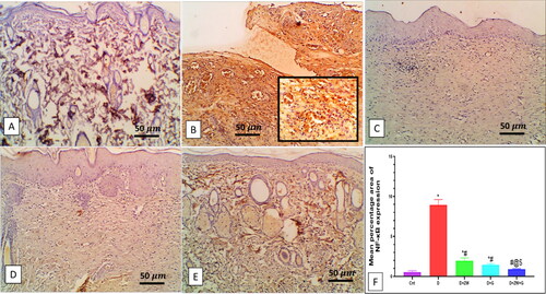 Figure 5. Representative photomicrograph of NF-κB expression in skin section of different groups. A: the control group shows no expression. B: the diabetic group shows high expression in epidermal and dermal cells, inset, high expression in the cytoplasm of invading polymorphonuclear and mononuclear cells. C and D: the Diabetic + ZW and diabetic + dapagliflozin groups show few expressions in epidermal and dermal cells. E: the diabetic + ZW + dapagliflozin group shows mild expression in epidermal and dermal cells. F: Histogram shows the percentage of skin that was immunostained with NF-κB. * vs. Control group; # vs. Diabetic group; @ vs. Diabetic + ZW group, and $ vs. Diabetic + dapagliflozin group. Image magnification = 400X, bar = 50 µm.