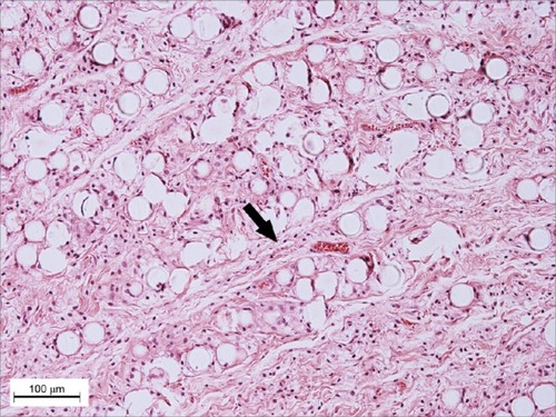 Figure 2 Microscopic appearance after 3 months: few inflammatory cells and formation of connective tissue septa within PMMA spheres.