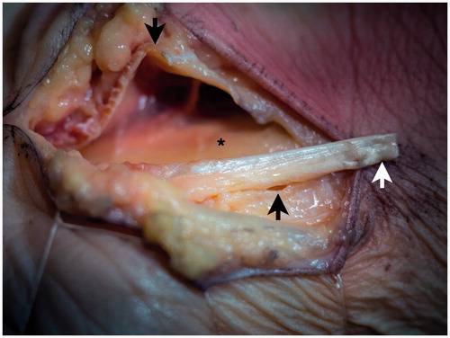 Figure 2. Intraoperative appearance in a cadaver. The palmaris longus tendon is dissected proximally. *: median nerve; Black arrows: flexor retinaculum; White arrow: palmaris longus tendon.