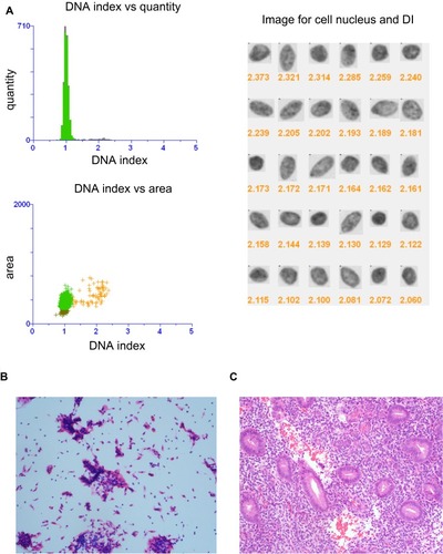 Figure 1 DNA quantitative analysis and cytological histopathological diagnosis of normal endometrium. (A) Quantitative analysis of DNA images of normal proliferative endometrium. DI, DNA index for short, which means the ratio of the DNA-IOD value of the tested cells to that of the normal cells. Cytological images (System scan cell under magnification, ×20.) (B) and histopathological images (magnification, ×200.) (C) of normal proliferative normal endometrium.