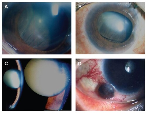 Figure 1 External photographs showing anterior segment of the eye. (A) Initial visit. A raised choroidal mass can be seen behind the lens. (B) Six weeks after first visit. The choroidal mass behind the lens has expanded to push the lens upward. (C) Three months after the first visit. The eye had a mature cataract, the anterior chamber has disappeared, and iris rubeosis is severe. (D) Seven months after the first visit. The tumor showed extraocular extensions through the sclera into the subconjunctival space.