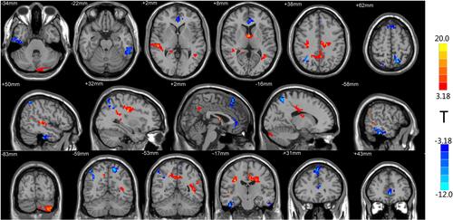 Figure 1 Brain regions with differential ReHo values after treatment. The distribution of ReHo differential brain areas in the transversal sections (upper row), sagittal sections (middle row), and coronal sections (third row) after treatment. The red and yellow colors indicate higher ReHo value, while blue colors indicate lower ReHo in PHN brain 6 months after treatment, compared with the admission day (P < 0.05, AlphaSim corrected, paired t-test, n=15). Brain areas with increased ReHo mainly in the temporal lobe, cerebellum, cingulate gyrus, and precuneus. Lower ReHo values were detected in the temporal lobe, anterior cingulate gyrus, and frontal lobe (Table 2).