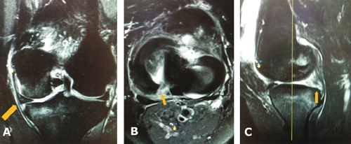 Figure 5. Visualization of meniscal root tears via magnetic resonance imaging. A. Coronal T2-weighted section demonstrating medial meniscal extrusion (arrow) (left knee). B. Axial image demonstrating high signal in region of meniscus root and posterior horn with a radial root tear (arrow) (right knee). C. Sagittal image demonstrating ghost sign (arrow) (right knee). Reprinted with permission from Bhatia et al. (Citation2014).