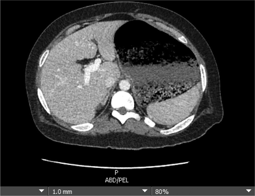 Figure 1. Severe gastric dilation in 21 year old male with PWS following food binge. Residual food is seen within the lumen of the extremely dilated stomach.