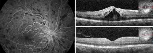 Figure 1 Fluorescein angiography (20.9 seconds) of one patient with recent onset central retinal vein occlusion in the right eye showing no evidence of ischemia in the macula (left). Gray-scale spectral domain optical coherence tomography (SD-OCT) horizontal scan at the initial visit (upper right) demonstrates prominent macular edema with cystoid spaces and serous retinal detachment under the fovea. The Snellen best corrected visual acuity was 20/200 at this point. This patient was treated with multiple intravitreal injections of bevacizumab. Gray-scale SD-OCT horizontal scan at the final visit (lower right) shows that macular edema has resolved completely. The inner segment/outer segment (IS/OS) junction can still be identified in the fovea, and there is a complete preservation of the inner retinal architecture. Visual acuity improved to 20/25 at final visit.