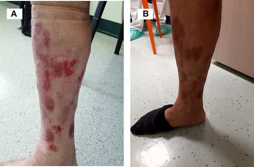 Figure 2 Right lesions of the leg before (A) and after (B) four cycles of mogamulizumab.