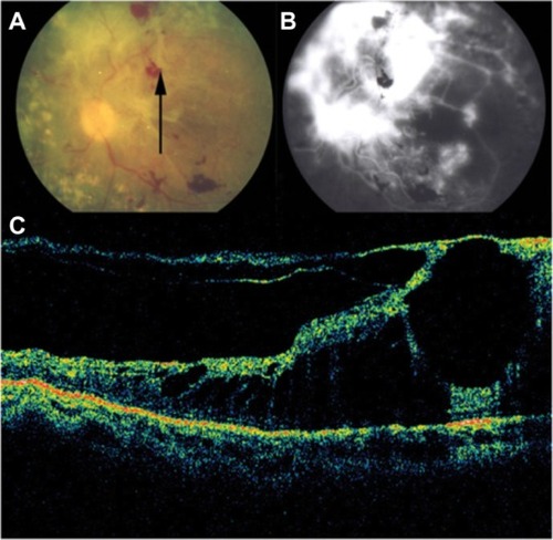 Figure 34 (A) Fundus photography, (B) fluorescein angiogram, and (C) Stratus optical coherence tomography of proliferative diabetic retinopathy with retinal traction and detachment.