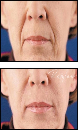 Figure 3 A clinical example of the use of Restylane® for nasolabial folds.