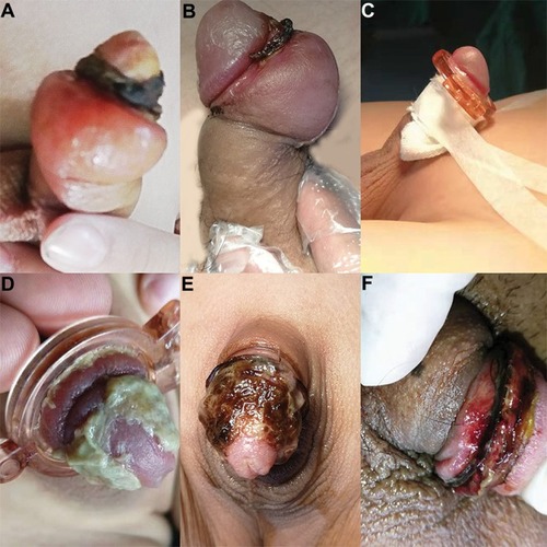Figure 2 The types of complication. Edema and scar (A), edema in the back side of penis (B), pressure dressing (C), effusion of yellowish fluid caused by phimosis when wearing CSR (D) and CSR removal (E) and wound dehiscence (F).