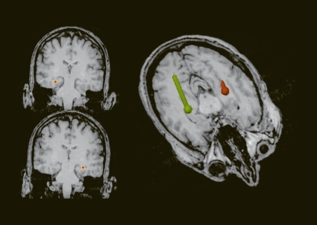 Figure 3. Limbic sources of P300m dipoles. Three-dimensional reconstruction of the major sources explaining the pattern presented in Figure 2. Note the location in the posterior part of the hippocampal formation.