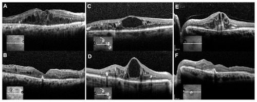 Figure 1 (A) A 55-year-old man with chronic macular edema from proliferative diabetic retinopathy, status post focal laser treatment (case 11 in Table 1). Preoperative vision was 20/200. The preoperative spectral-domain OCT shows cystic edema mostly in the outer nuclear layer. The macular thickness measured 527 μm. (B) Postoperative OCT 5 months later shows resolution of cystic macular edema. Visual acuity is 20/100, and macular thickness is decreased to 262 μm. (C) A 67-year-old woman with chronic macular edema from nonproliferative diabetic retinopathy, status post focal laser, intravitreal bevacizumab and triamcinolone injections (case 14 in Table 1). Preoperative vision was 20/100. The preoperative spectral-domain OCT shows an attached posterior hyaloid, a large cystoid space, and cystic edema, mostly in the outer plexiform layer. The inner/outer segment junction is intact. Macular thickness measured 543 μm. (D) Postoperative spectral-domain OCT 5 months later shows worsening of the central cystoid space. Central foveal thickness increased to 605 μm, but vision improved to 20/80. (E) A 68-year-old man with chronic macular edema from nonproliferative diabetic retinopathy without previous treatment (case 10 in Table 1). Preoperative vision was 20/200. The preoperative spectral-domain OCT shows an attached posterior hyaloid and cystic edema in the inner and outer plexiform layers as well as evidence of trace subretinal fluid. Central foveal thickness measured 655 μm. (F) Postoperative spectral-domain OCT 8 months later shows resolution of macular edema (central foveal thickness 385 μm), but subretinal fibrosis is evident. The inner/outer segment junction is attenuated subfoveally. Visual acuity is decreased to counting finger vision.