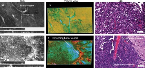 Figure 6 Representative images of a mouse glioma showing abnormal microvasculature, specifically abnormal capillaries (upper row) and abnormal large vascular channels within the tumor (lower row). (A) and (D) represent 2D projections of CLE Z-stacks shown in volumetric views (B) and (E), respectively. Correlative histologic slides stained with H&E from the same tumor sites are shown in (C) and (F). The vascular pattern cannot be fully appreciated on 2D CLE and H&E images; however, the volumetric views allow the viewer to see the abnormal vasculature patterns. Image (B) shows areas of bright fluorescence in green, whereas areas of darkness are in orange. On the right side of the image, the dye infiltration into loosely arranged tumor cells can be appreciated. The volumetric view is presented as a single channel using customized spectrum LUT (Fiji).Note: Used with permission from Barrow Neurological Institute.Abbreviations: 2D, two-dimensional; CLE, confocal laser endomicroscopy; H&E, hematoxylin and eosin; LUT, look-up table.
