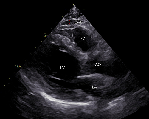 Figure 2 Ultrasound diagnostic apparatus assessment of epicardial adipose tissue (EAT) which was marked by the red arrow.