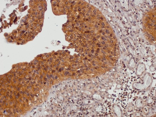 Figure 2 Bladder carcinoma (TCC) (HBlaU066Su01, position C10) (74-year-old male, grade II, stage 1, T1N0M0, malignant bladder cancer) probed anti-TM, counterstained with hematoxylin (magnification 200x).