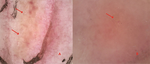 Figure 2 Dermoscopy images: (A) a tunnel with red arrows formed by larva migration. (B) high refractive dots with red arrows, which may be larval body or paws.