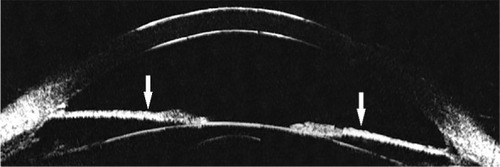 Figure 4 Ultrasound biomicroscopy image using the Humphrey-Zeiss model 840 (San Leandro, CA, USA [50 MHz]) showing essential iris atrophy.