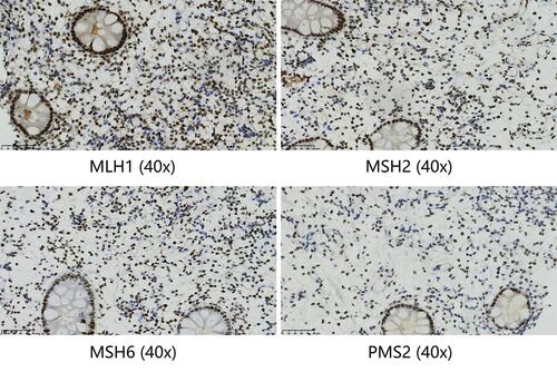 Figure 3 Immunohistochemical staining for MLH1, MSH2, MSH6, and PMS2 on the intestinal biopsy samples reveal loss of MLH1 and PMS2 protein expression (40x).