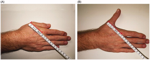 Figure 5. During radial adduction (A) and radial abduction (B), we assessed the intermetacarpal distance between the mid-dorsal points of the first and second metacarpal heads, indicated by the red bar.