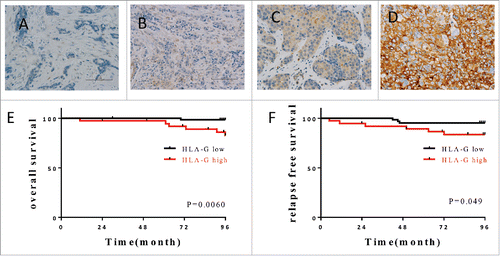 Figure 1. Expression of HLA-G in breast cancer correlates with outcome. Examples of immunostaining intensity: (A) no staining; (B) weak staining; (C) moderate staining and (D) strong staining used for establishing classification of the level of expression. (E, F) The Kaplan–Meier graphs was used to estimate the correlation of HLA-G expression with overall survival and relapse-free survival. Log-rank tests were used to assess significance (p values).