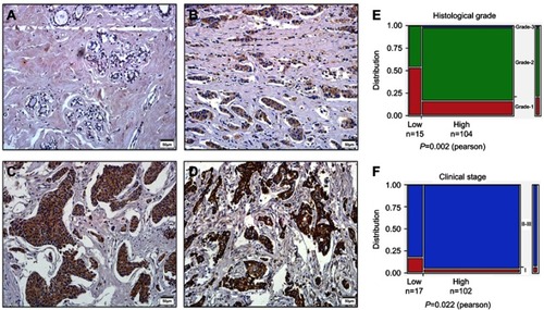 Figure 3 IHC staining of HSDL2 protein in breast cancer and normal breast tissues.Notes: (A) Negative HSDL2 protein in normal breast epithelial tissues. (B) Weakly positive HSDL2 protein in breast cancer tissues. (C) Moderately positive HSDL2 protein in breast cancer tissues. (D) Strongly positive HSDL2 protein in breast cancer tissues. Original magnification, A-D: ×200. (E-F) The expression level of HSDL2 protein was significantly related to differentiation (p=0.002) and clinical stage (p=0.022).