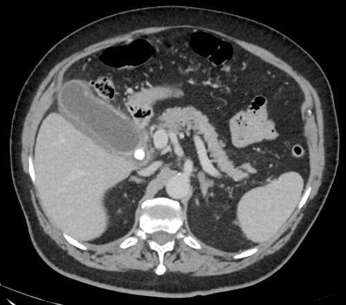 Figure 1 Acute cholecystitis (AC) with distended gallbladder, stones, mucosal hyper-enhancement and pericholecystic fluid noted on computed tomography (CT) scan.