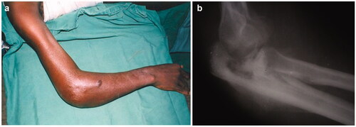 Figure 2. Osteomyelitis as an insidious, destructive condition. Radiographic features (b) may overpass surface clinical appreciation (a).