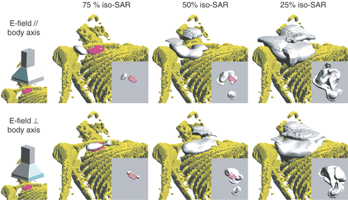Figure 10. SAR coverage for E-field directions parallel (top) and perpendicular (bottom) to the body axis. The 75%, 50%, and 25% iso-SAR surfaces are depicted. The insets show the inferior view of the tumour's SAR coverage.