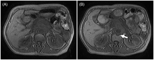 Figure 3. (A) MRI scan made before HIFU treatment which demonstrates a tumour in the body of the pancreas. (B) MRI scan demonstrating a vertebral injury (arrow) after HIFU treatment. Pavg of HIFU for this case was 208 W and DI was 6.9 kJ/cm3.