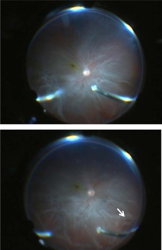 Figure 4 Fundus view of wide-angle viewing system alone (top) and use of our contact lens with the wide-angle viewing system (bottom).