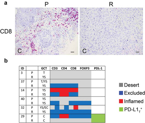 Figure 5. Density of tumor-infiltrating T cell subsets and tumor PD-L1 in primary and relapsed meGCTs a, Representative IHC images of CD3+ T cell staining in primary (P) and relapsed (R) meGCT samples. Original magnification, x20. Scale bar, 30 µm. b, Distribution of TIL subsets and PD-L1 expression in primary and relapsed meGCTs. T, teratoma, YS, yolk sac tumors; EC, embryonal carcinoma; C, choriocarcinoma.