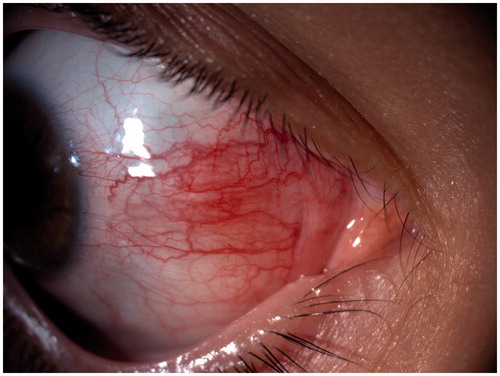 FIGURE 1. Mild scleritis recurrence with full response to local treatment.