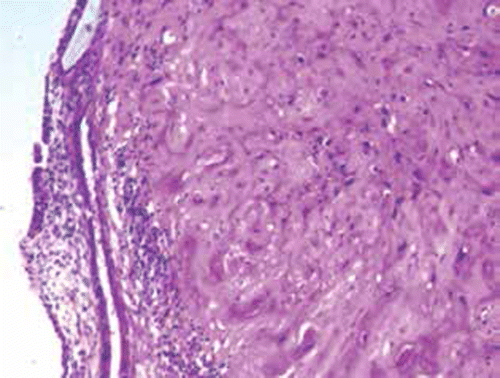 Figure 2: Medium power magnification view of the histology of the tumor in case 2, showing a nodule of mostly hyalinised tumor. Haematoxylin and eosin, 100 × magnification.