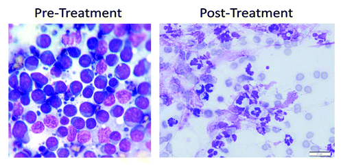 Figure 8. Cytology of the pre-scapular lymph node in the lymphoma patient. Pre-treatment, cytology shows a monomorphic population of lymphoblasts that have round to slightly irregular nuclei in a scant amount of circumferential basophilic cytoplasm. The nuclei also contain large nucleoli. Lymphoglandular bodies are present in the background. Post-treatment cytology shows many degenerate neutrophils, few macrophages, rare reactive fibroblasts, many ruptured cells, abundant streaming nuclear debris, and moderate numbers of erythrocytes. No atypical cells are identified.