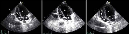 Figure 2. Apical four-chamber echocardiography images at 0, 8 and 14 weeks in DHMCT group.