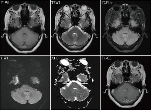 Figure 3 Magnetic Resonance Imaging (MRI) for breast cancer combined with brain metastasis in a 50-year-old female patient. T1WI revealed an irregular hypointense nodule in the cerebellar vermis; T2WI and T2Flair showed slightly hyperintense signals; diffusion-weighted imaging (DWI) presented an isointense signal; the mean apparent diffusion coefficient (ADC) value of the lesions was 0.813 x 10(-3) mm²/s; and T1-CE demonstrated significant enhancement of the lesion.