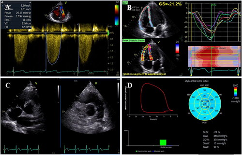 Figure 1. (A) Tracing the tricuspid regurgitation velocity-time integral; (B) analysis of speckle tracking echocardiography-derived right ventricular global longitudinal strain; (C) evaluation of the event timings of the tricuspid valve and pulmonic valve in the parasternal short-axis views; (D) measurement of right ventricular myocardial work by incorporating pulmonary pressures, right ventricular strain and cardiac cycle timings.