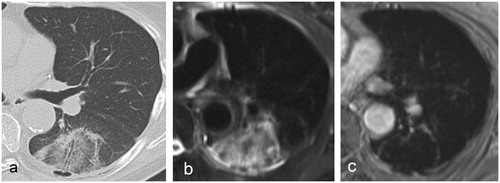 Figure 4. 24-h post-MWA aspect of a colorectal cancer metastasis in a 64-year-old patient on (a) CT, (b) T2 and (c) ceT1. The peripheral rim is visible on both CT an MR images. The ablated tumour cannot be visualised on either image, most likely due to its small size. No local tumour progression was recorded.
