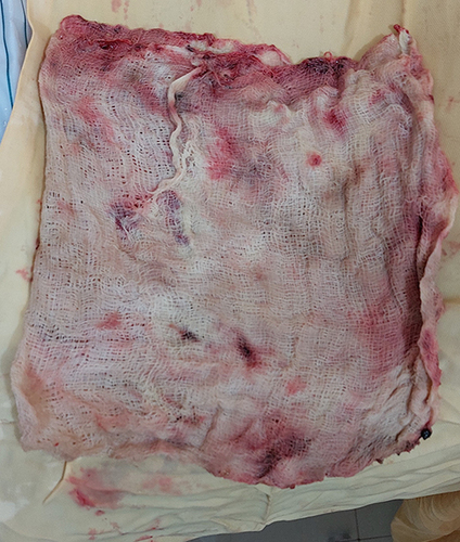 Figure 7 Removed surgical specimen containing surgical gauze soaked with pus.