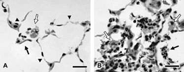 Figure 3 Alveolar septal damage (A) and inflammation (B) in the parenchyma of female A/J mice exposed to cigarette smoke for 15 weeks. Note the alveolar septal attenuation or breaks (arrowheads) and alveolar septal fragments (black arrow, A). Also present are neutrophils and vacuolated macrophages (white arrow, A). A focus of relatively severe inflammation (B) is composed of exudates of neutrophils (black arrow) and macrophages (white arrows) within alveolar air spaces. Macrophages are often vacuolated and contain pigmented cytoplasm. Bars = 20 µm.