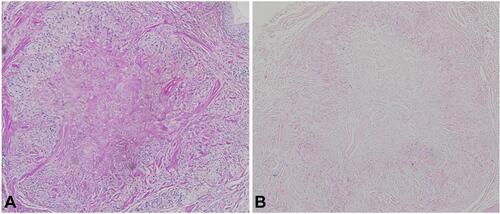 Figure 3 Immunohistochemistry of the patient. The granuloma of the patient was not immunohistochemically stained with PAS or Alcian blue, revealing no fungal infection or mucin deposition. (A PAS, ×100, B Alcian blue, ×100).