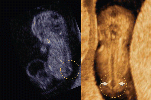 Figure 25.  Spina bifida at 9 weeks of gestation. Left; 2D sagittal image. Cystic formation was seen (white circle) at lumber part. Right; 3D image of neural tube. Clear dilatation of the neural tube is demonstrated (arrows).