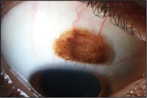 Figure 1 Initial slit-lamp image showing an 8 mm × 6 mm large pigmented lesion with numerous small cysts in the superior bulbar conjunctiva of the right eye.