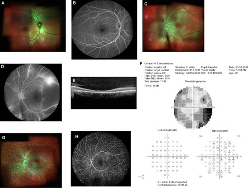 Figure 2 Fundus imaging and visual field analysis of the patient with ophthalmic artery occlusion.