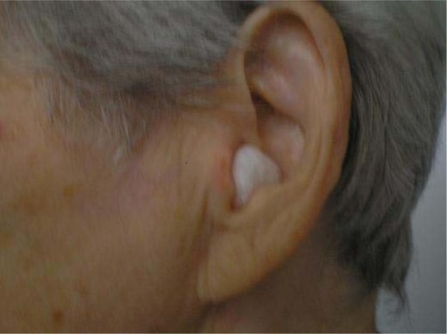 Figure 6 Clinical aspect after cryotherapy: no ulceration, no tumoral lesion, just a slight area of erythema.