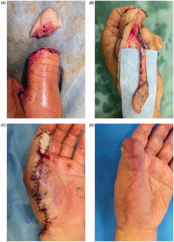 Figure 3. (A) Complete left thumb amputation. No vessel enabling anastomosis was available. (B) Flap of a reverse homodigital dorsal radial flap. (C) Flap grafting. Simple plication of the flap pedicle was difficult. Thus, the avulsed finger skin was grafted to the pedicle-everted area. (D) One month after surgery. No contracture of the donor site or no disturbance in motor function.