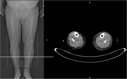 Figure 2 Computed tomography image of the altered limb.